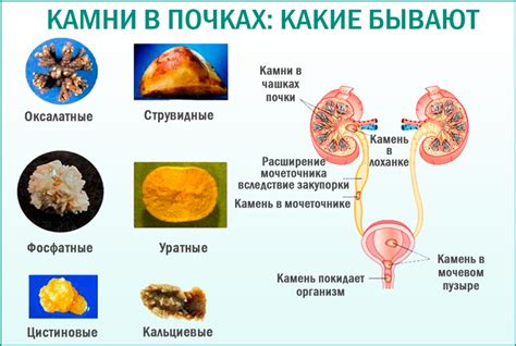 Особенности применения грелки для лечения камней в почках у беременных женщин