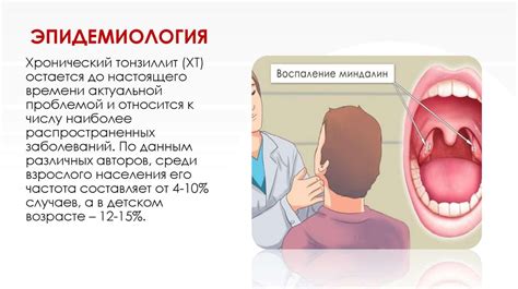 Особенности хронического тонзиллита у детей