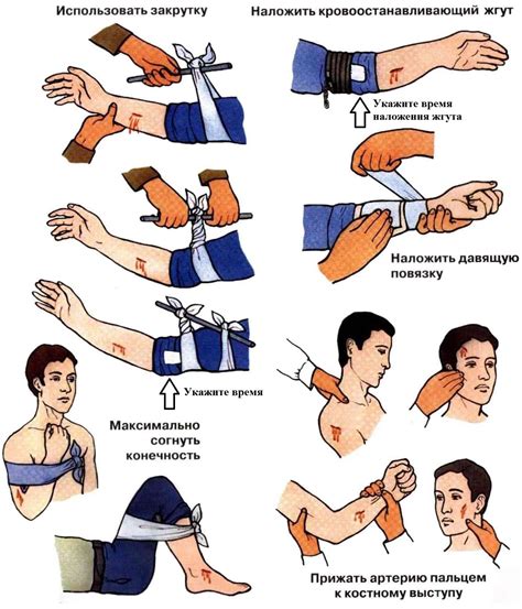 Остановка кровотечения с помощью давления