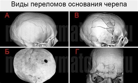 Открытое повреждение черепа и его последствия