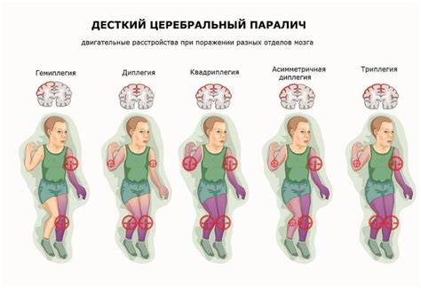 Паралич и его фатальное влияние