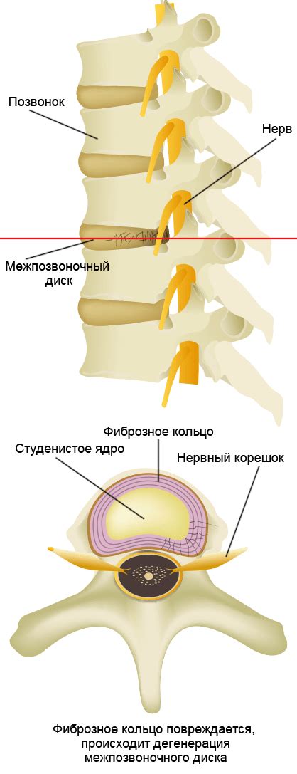 Передвижение межпозвоночных дисков