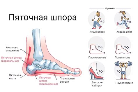 Плантарный фасциит как причина ночных болей у детей