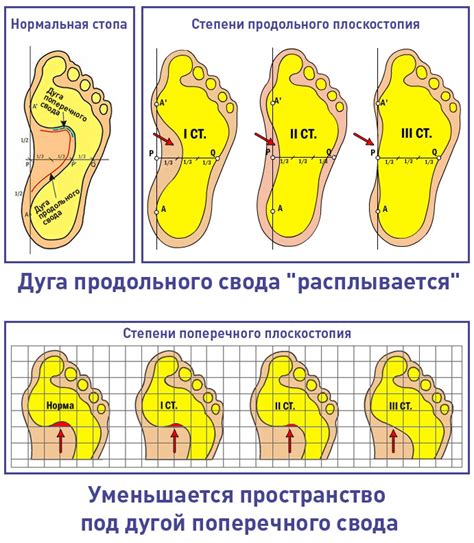 Плоскостопие как причина ночных болей у детей