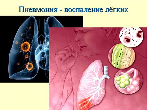 Пневмония и сон