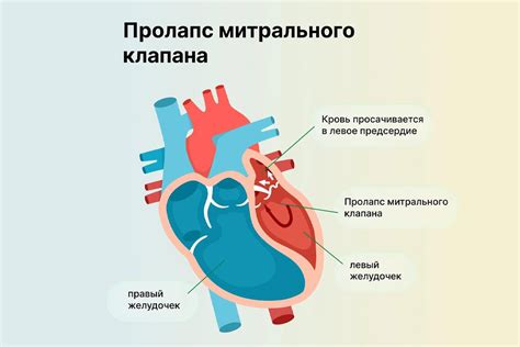 Повышенное давление в полости сердца и пролапс митрального клапана