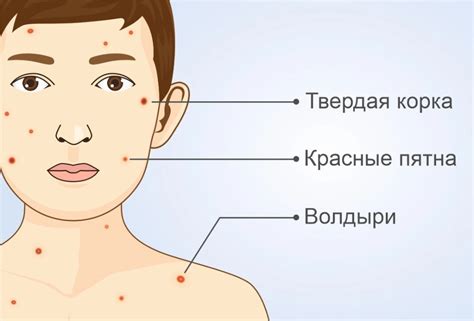 Последствия ветрянки без сыпи