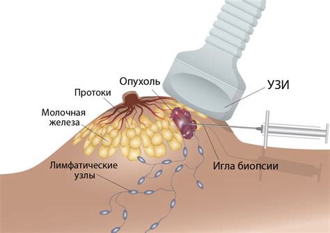 Потенциальные осложнения после биопсии