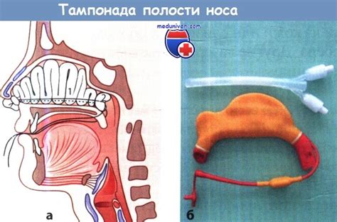 Поток крови при переломе носа