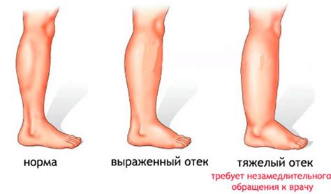 Почему возникает отек стопы при подагре?