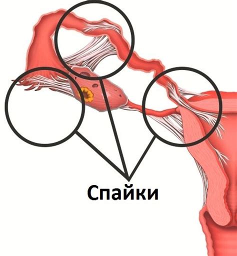 Почему спайки не всегда возникают после операции?