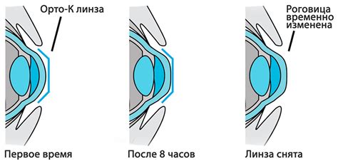 Правила снятия линз после коррекции зрения