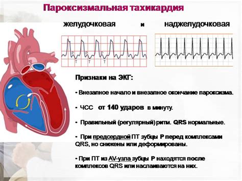 Преимущества физкультуры при тахикардии