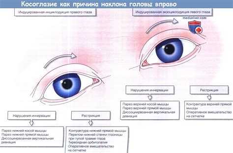 Причины наклона