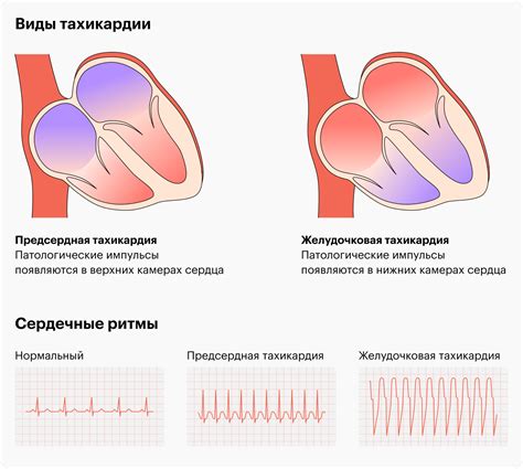 Причины усиленного пульса при лежании