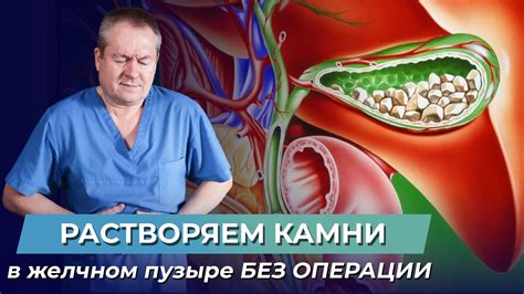 Профилактика образования камня в желчном пузыре