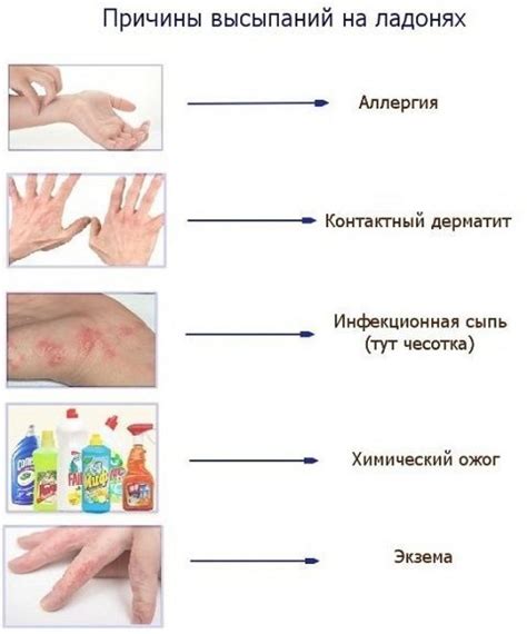 Профилактические меры: как избежать волдырей