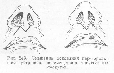 Процесс заживления прокола в носу