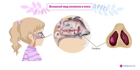 Развитие полипов