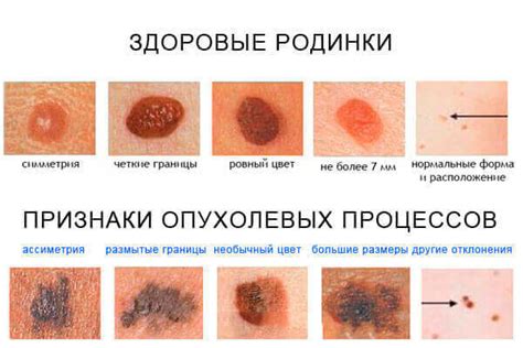 Рак кожи и зуд: на какой стадии возникают симптомы?