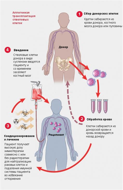 Рак крови: пересадка костного мозга