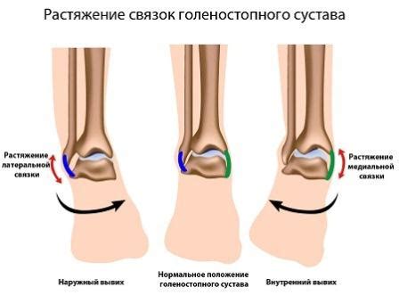 Растяжение связок: можно ходить или нет?