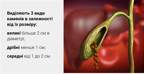 Риски оперативного удаления камня в желчном пузыре