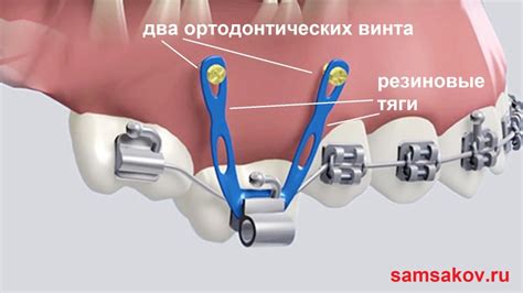 Роль резинок в ортодонтическом лечении
