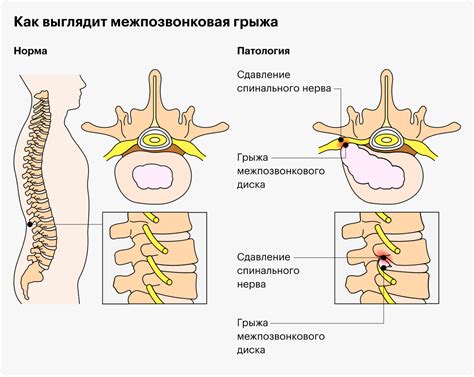 Связь повышенной температуры с другими симптомами грыжи позвоночника