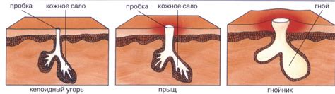 Секреция жидкости при выдавливании прыща