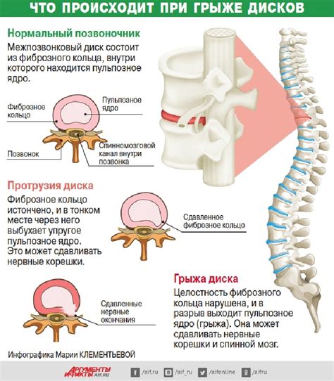 Симптомы грыжи спины