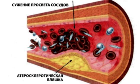 Симптомы и признаки наличия атеросклеротических бляшек