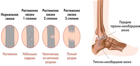 Симптомы и причины растяжения связок