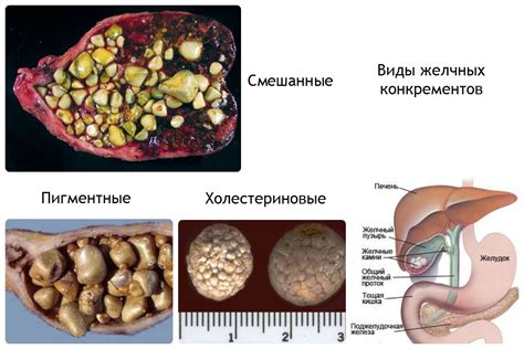 Симптомы камня в желчном пузыре - когда беспокоиться?