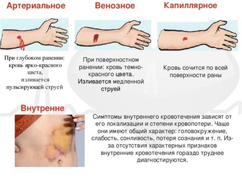 Симптомы кровотечения от приема Эликвиса