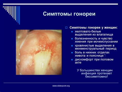 Симптомы при лечении гонореи: первоначальная стадия