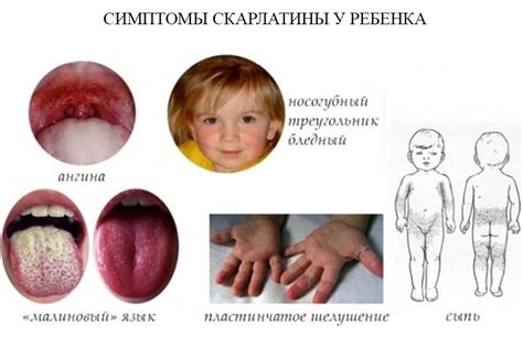 Симптомы скарлатины у детей