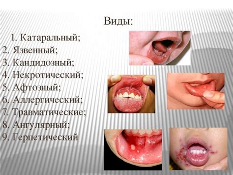 Симптомы стоматита у ребенка