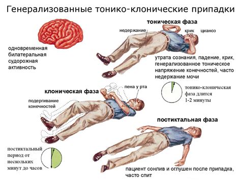 Симптомы эпилепсии