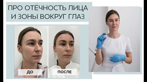 Сколько длится отечность после процедуры