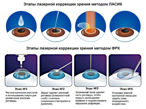 Сложность коррекции зрения