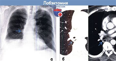 Сроки восстановления после лобэктомии легкого