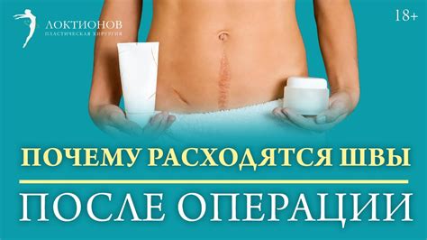 Сроки рассасывания саморассасывающихся швов после операции