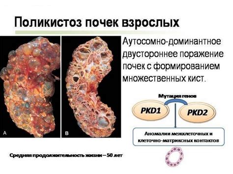 Степень опасности полипов на почке