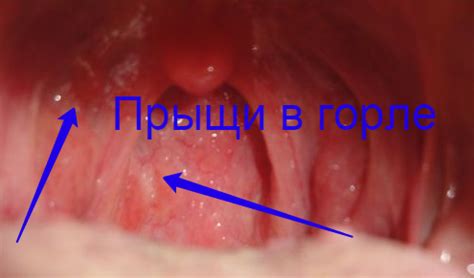 Сухость и покраснение горла