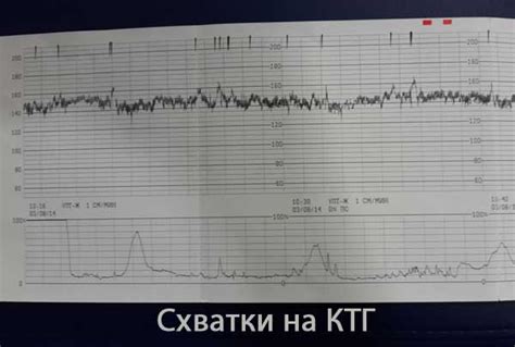 Схватки на КТГ: врачебное мнение о том, когда приходит время рожать