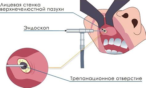 УОЗИ и мониторинг состояния кисты