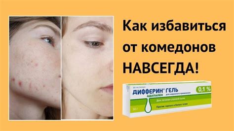 Удаление комедонов на лице: мнение экспертов