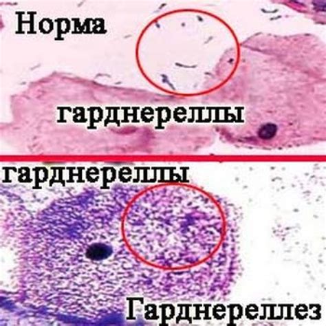 Уреаплазма у женщин: причины и симптомы