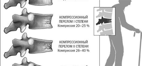 Факторы, влияющие на шансы ходить после повреждения позвоночника